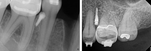 correct placement of  mini implant temporary anchorage device Tads